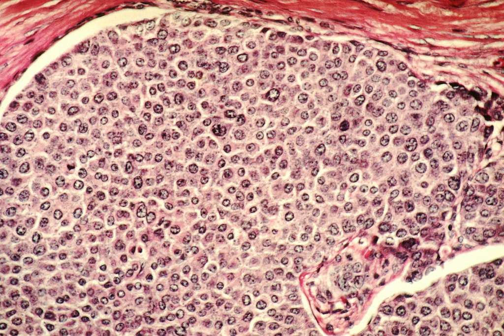 La melatonina presenta potencial antimetastástico